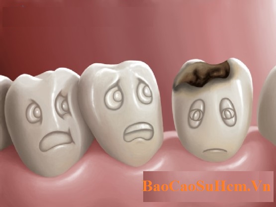 Lười đánh răng và chăm sóc răng miệng