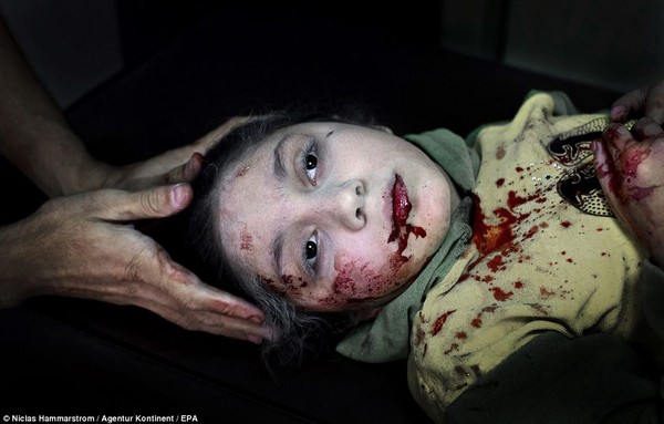 Ánh mắt ám ảnh của bé gái 11 tuổi bị thương trong cuộc nội chiến Syria 2