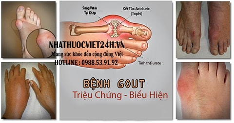 dấu hiệu của bệnh gout