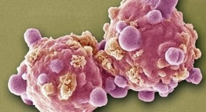 tế bào ung thư